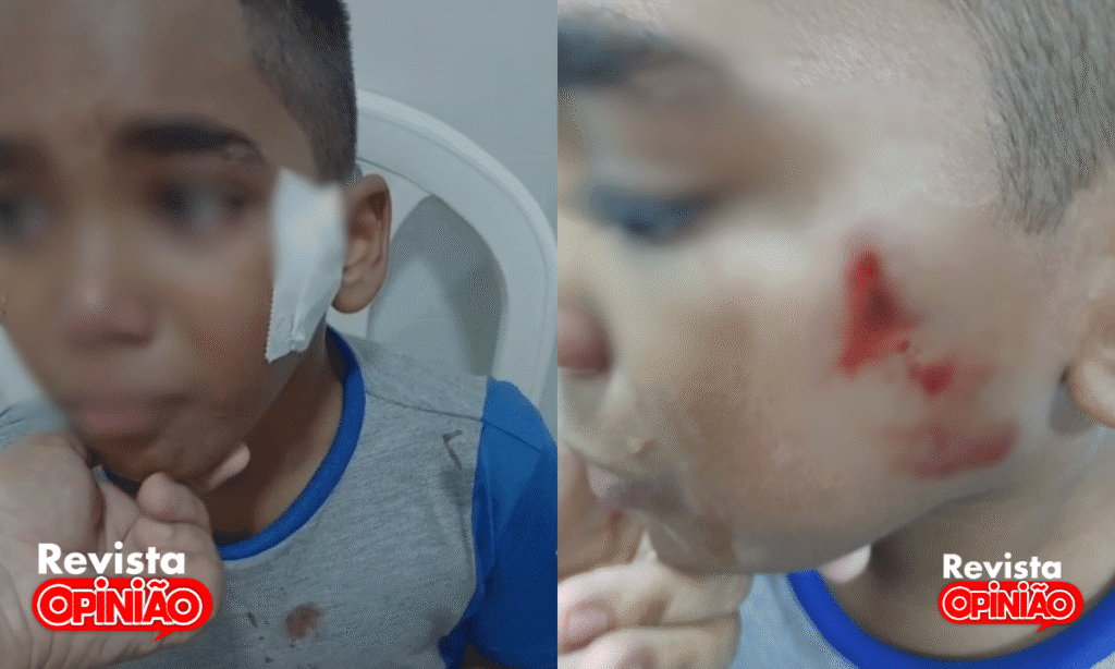 Criança sofre corte profundo em acidente com balanço em escola de José de Freitas 1 crianca acidente 2
